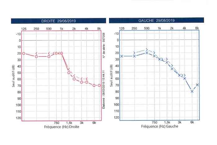Audiogramme presbyacousie